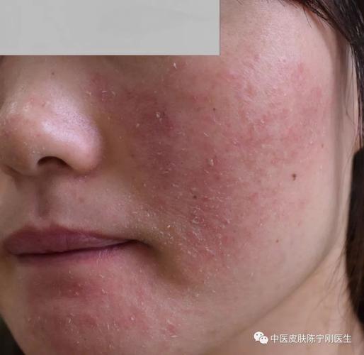 面部皮炎怎么护理?