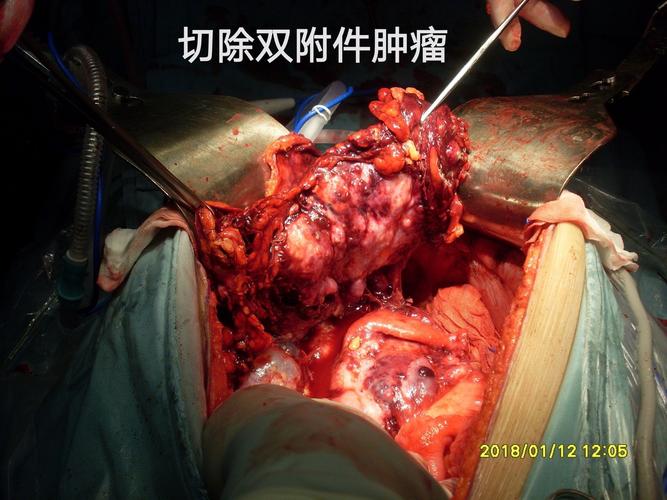 病例96--Ⅲ期卵巢癌完全crs hipec后18个月肠梗阻再次手术