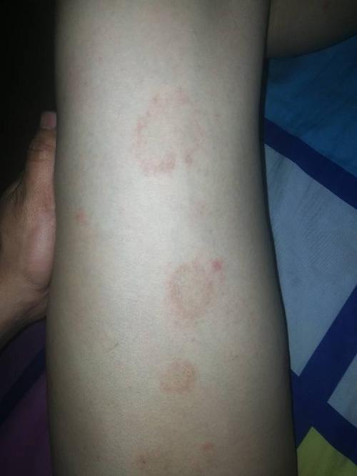 大腿内侧出现圆圈状的红斑,以前只有右腿有,现在左腿也开始出现了,不