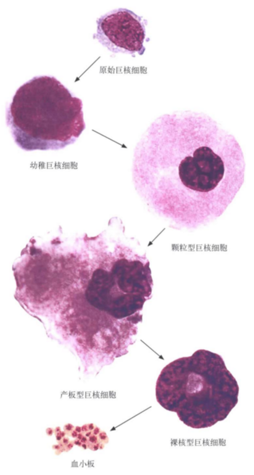 巨核细胞:又分颗粒巨,产板巨和裸核幼稚巨核细胞:原始巨核细胞:巨核