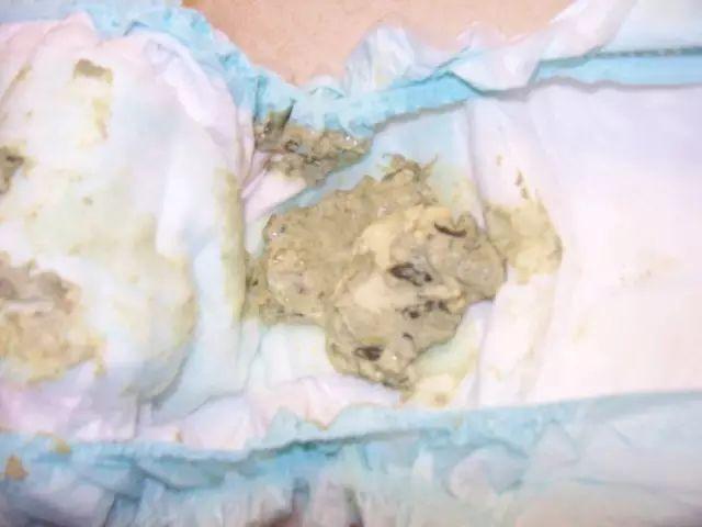 如果宝宝的便便呈现白色或陶土色,可能 存在严重的肝脏疾病,要及时带