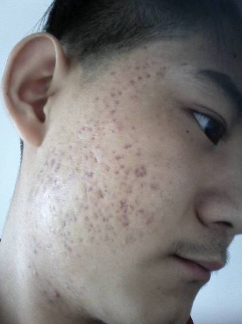 两边脸上都有很多的痘印 都快1个多月了也没有消退.我