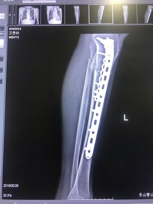 王贵林,胫骨上段骨折