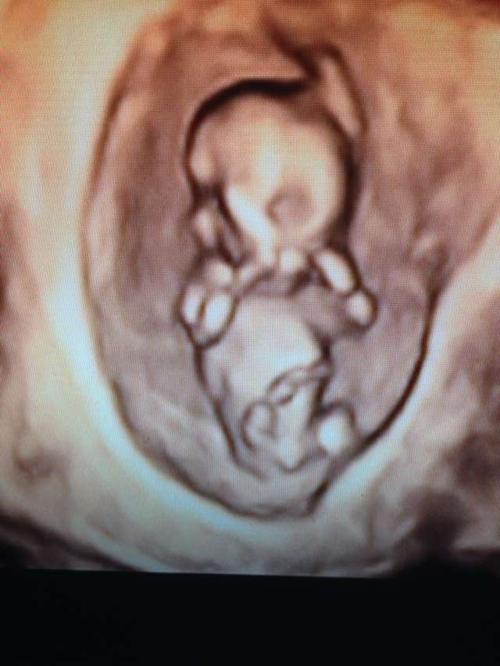 b超单数据能看男女?关于分辨胎儿性别的四个谣言孕妈可别再信了