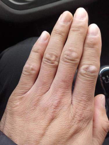 手指背面关节处皮肤变粗变硬,没有纹理了,这是怎么回事?