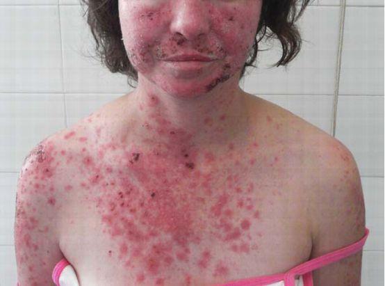 红斑狼疮的"光敏感",究竟是什么?