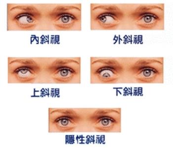 孩子斜视粗心妈妈以为孩子在搞怪