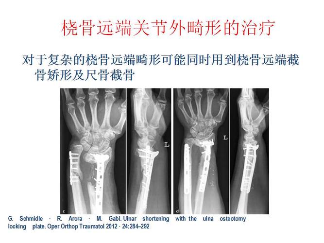 桡骨远端畸形愈合治疗