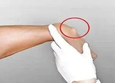 健康来了丨若有这5个表现该留意腱鞘炎