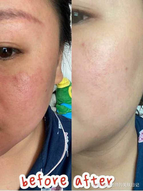 为什么脸上的皮肤老烂 皮肤很薄?