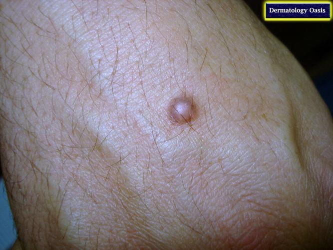 皮肤纤维瘤是什么?它会恶变吗?