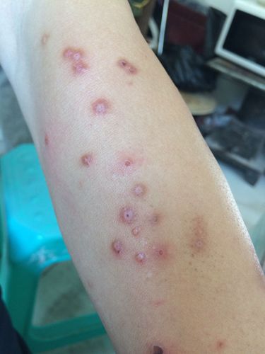 这个疮个把月了还没好很痒是什么疮