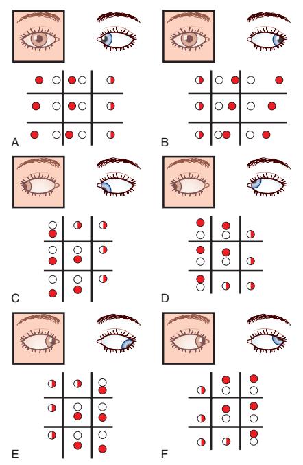 3个问题,轻松掌握复视诊断定位