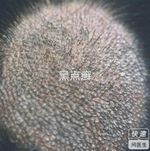 孩子得了头癣怎么办