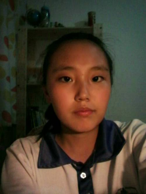 我这算很严重的斗鸡眼吗?可以矫正过来吗?可以渐渐变好吗?