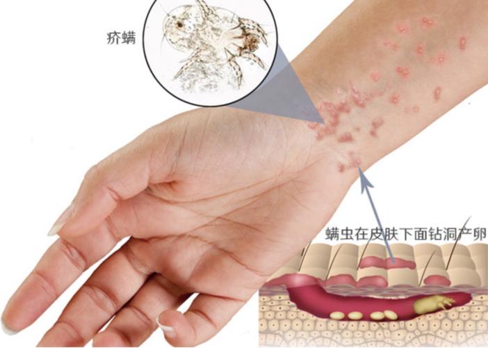 皮防科普丨一人感染 全家遭殃的疥疮