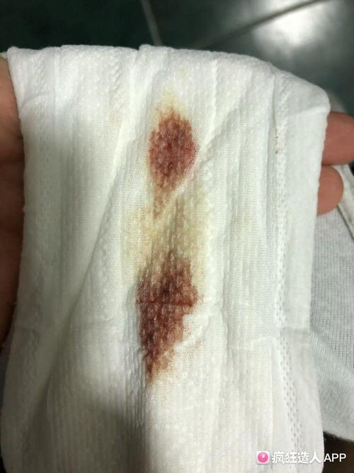 这是要来月经了?还是宫外的点滴出血?