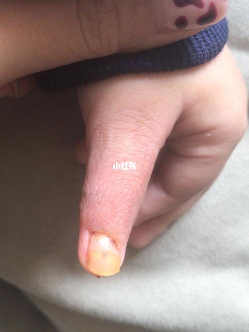 蟹钳多指手术后_儿童医院_蜕皮_保鲜袋_母婴_育儿经验
