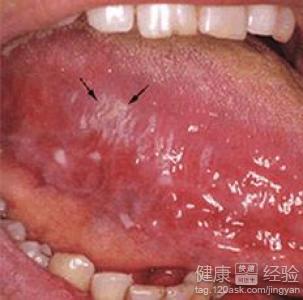 口腔扁平苔藓有偏方吗