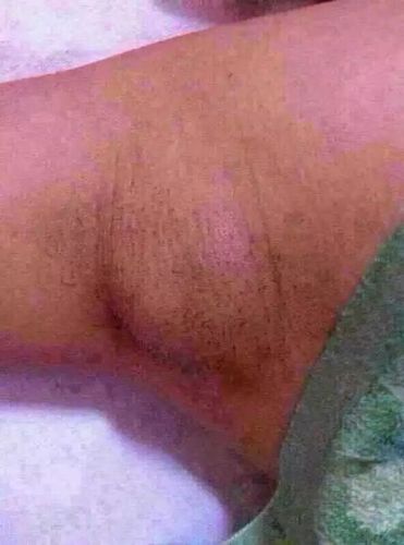 淋巴堵塞,毒素堆积,身体会癌变!您警惕了吗?