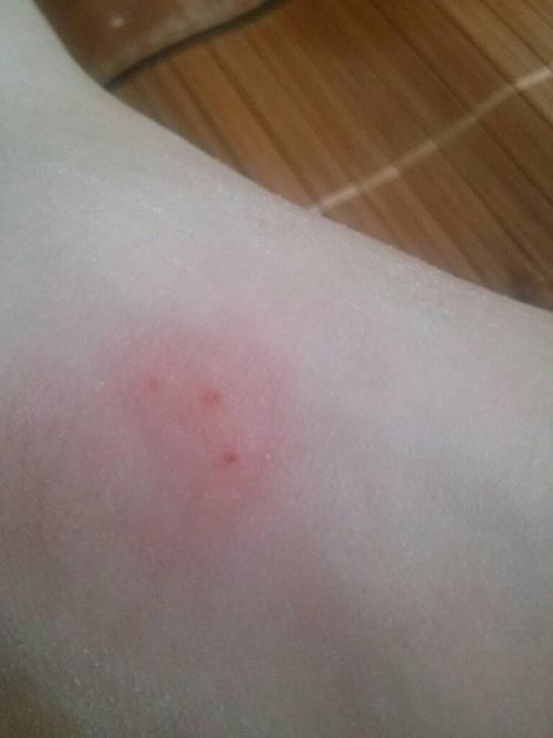 巨痒 不像被蚊子咬的 有点肿 而且应该擦一些什么药好?