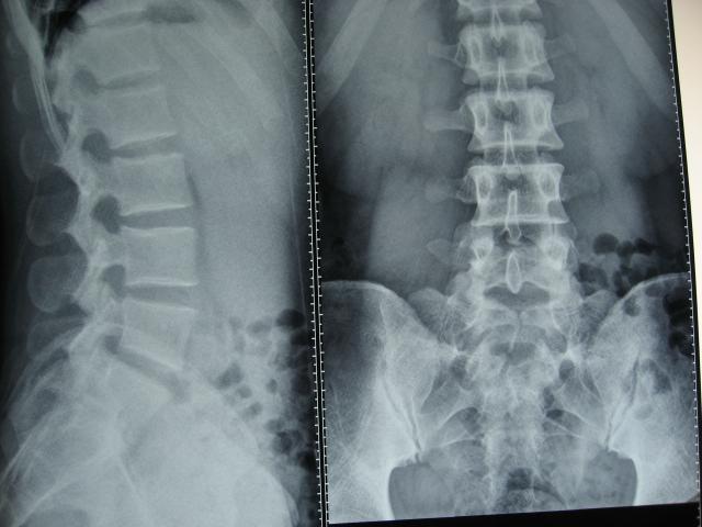 第五腰椎的隐性裂,腰椎骶化