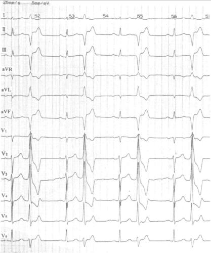 图14-19 多形性室性早搏二联律