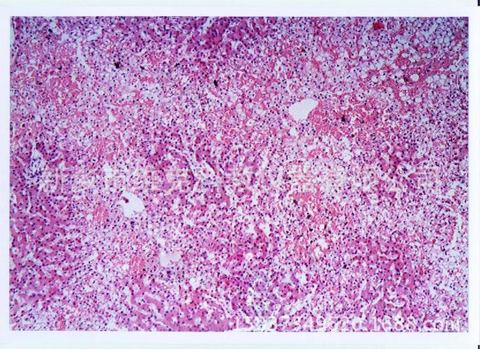 人慢性肝淤血切片 生物切片 人体病理学类 局部血液循环障碍
