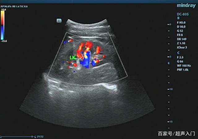 超声入门:肾结石超声诊断