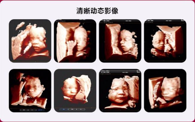 5d彩超孕期大排畸的首选可视化立体智能彩超了解一下