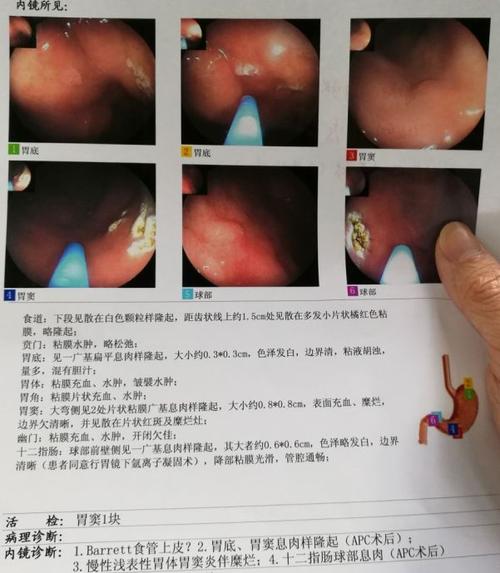 如果局部有隆起性病变可能是 胃息肉,胃平滑肌瘤