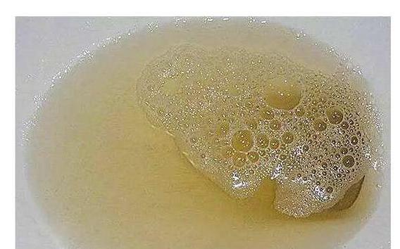 做好4点或能改善尿蛋白!