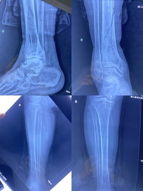 快速康复之胫骨骨折(mipo技术的应用)
