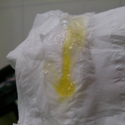 咳出亮黄色的痰是怎么回事 感冒一个多星期先是绿色的