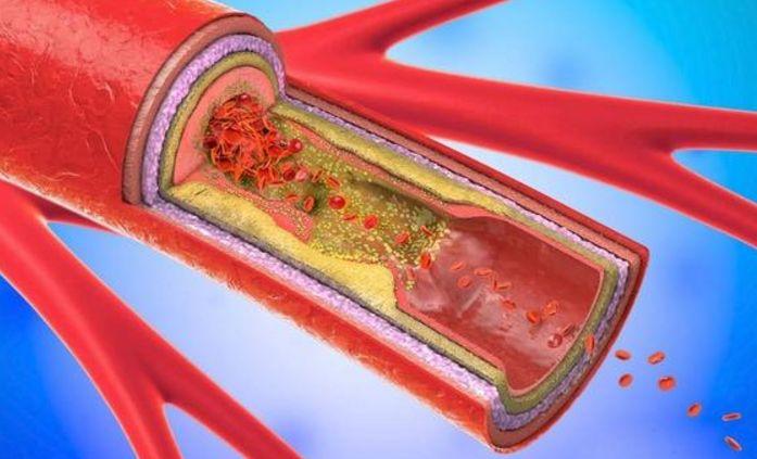 动脉硬化的临床症状有哪些,这四点你都要了解明白哦!
