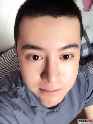 男生全切双眼皮 鼻综合整形手术过程分享 阳光帅气get!