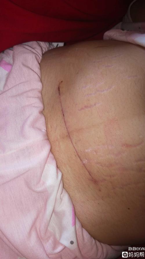 剖腹产十天的伤口