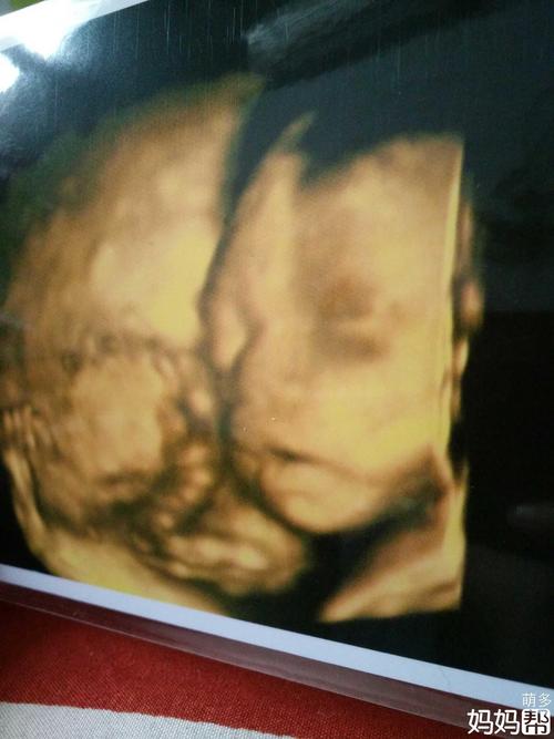 bc图胎儿和妈妈面对面是儿子?反之面朝外的是女儿吗?