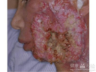 概 述 癌症其实一直就在大家的身边,隔壁邻家的黄大妈今年已经50岁