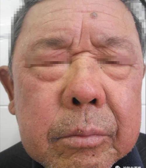 光过敏多形性日光疹