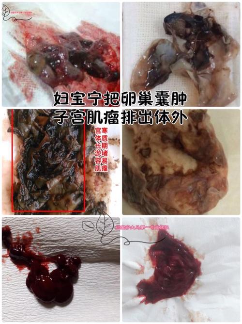 血瘤案例～巧克力囊肿