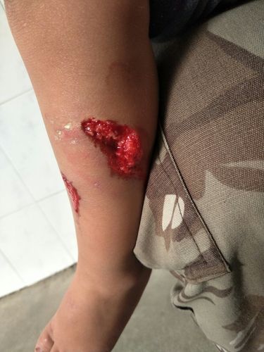 这个伤口是被狗咬的,我想请问一下能定伤残吗