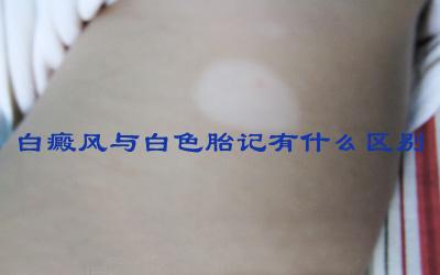 白癜风与白色胎记有什么区别