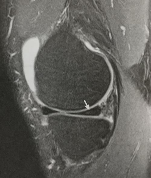 浅谈半月板损伤2