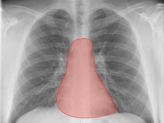 提起"胸透"很多女性还是很害羞的,因为这牵扯到女性的隐私方面