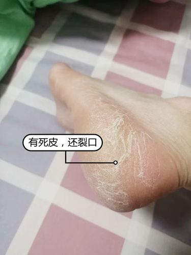 角质增厚,易裂脚