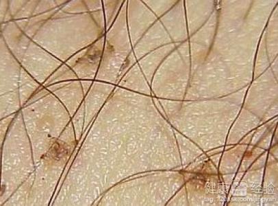 阴虱是哪些因素引起的