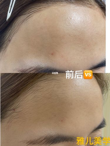 发际线额头脱毛一次对比效果_发际线_脱毛_黄海大市场