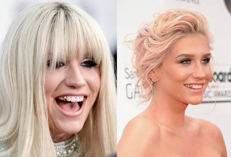 歌手ke$ha就有一颗标志性的小金牙,笑起来的时候小金牙好抢戏. ▼