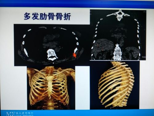 骨折的x线诊断